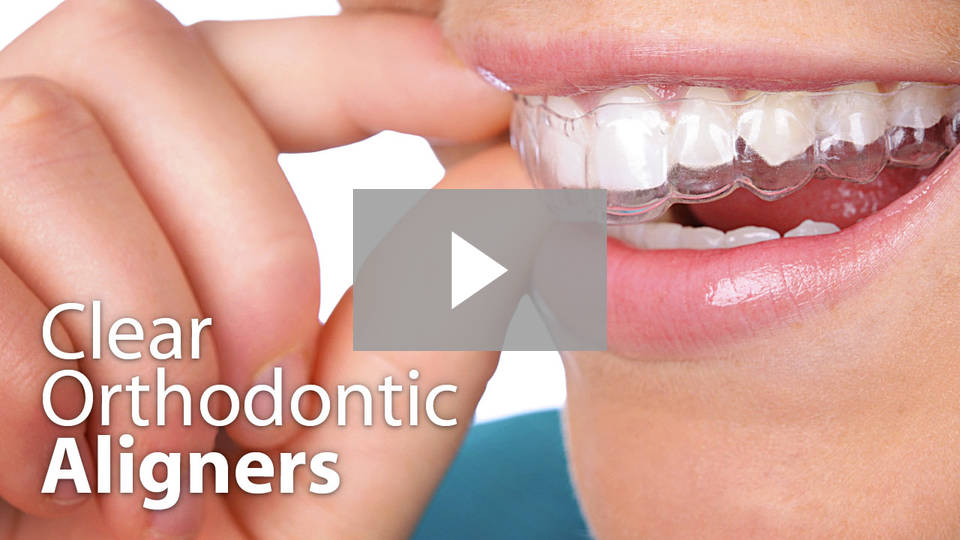 Clear orthodontics with Invisalign in Guelph, ON