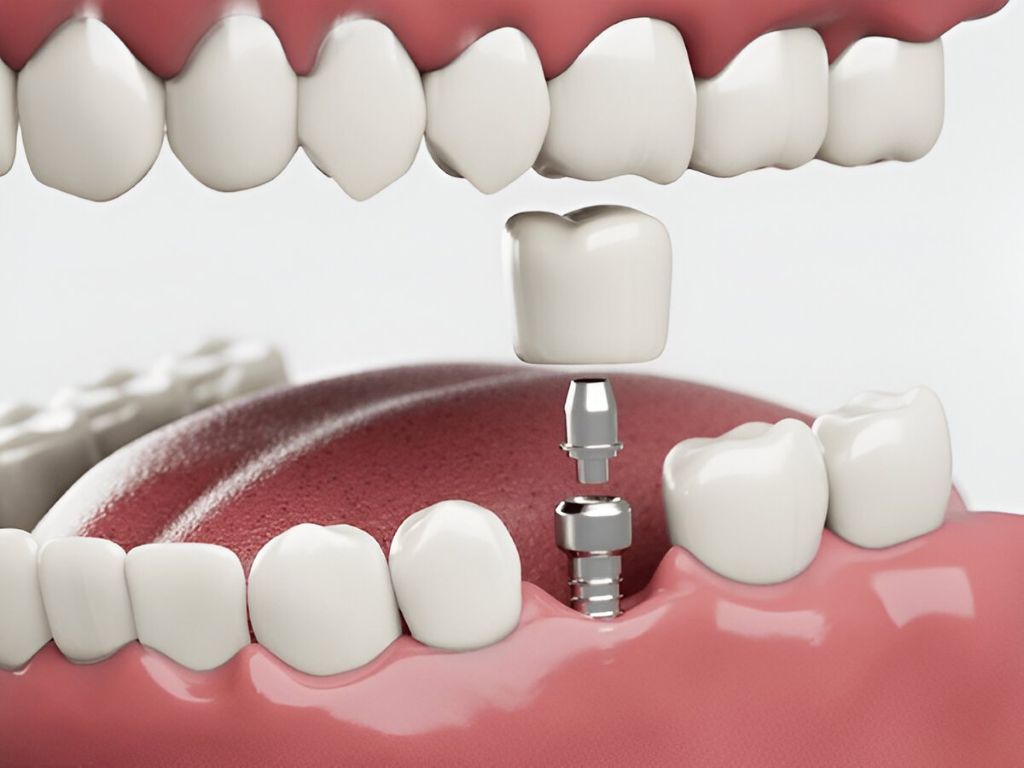 dental implant near you