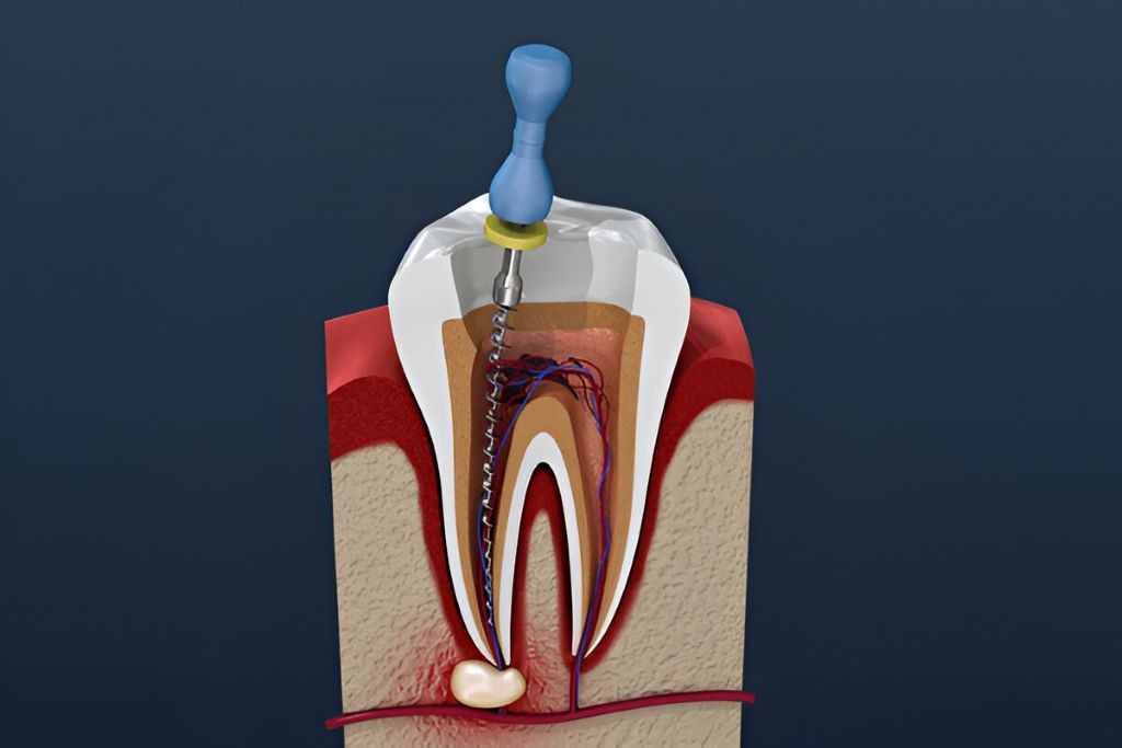 root canal therapy near you